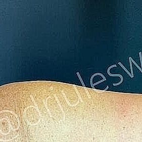 Arm Lift Brachioplasty Before & After