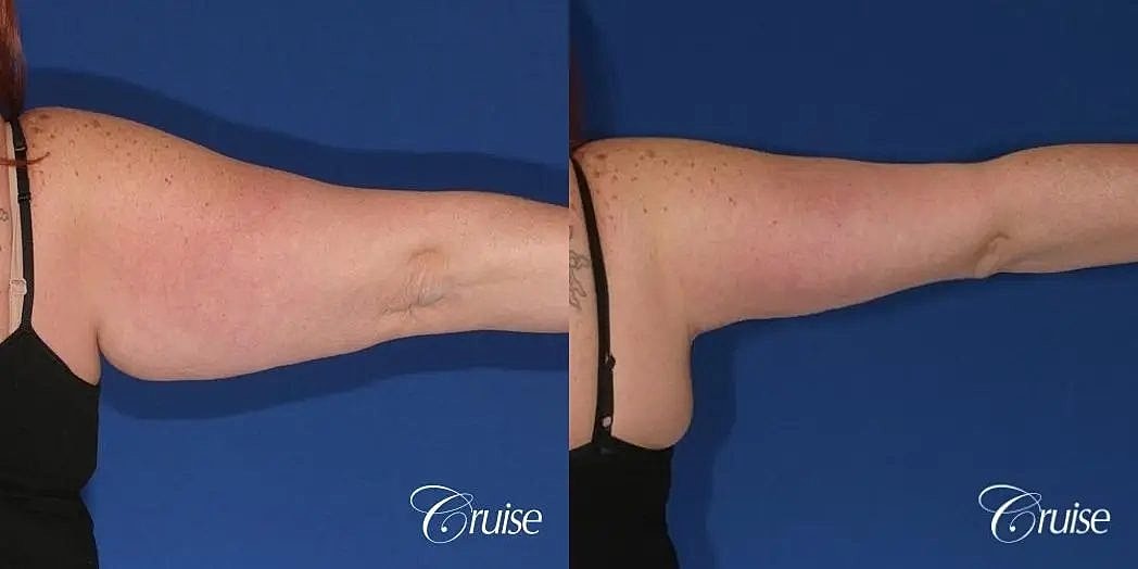 Arm Lift Before & After