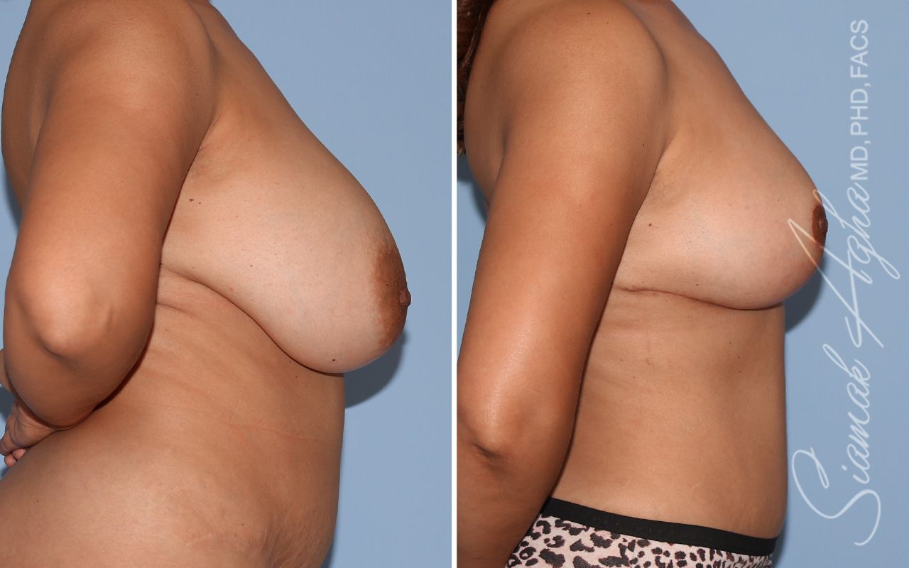 Breast Lift Before & After
