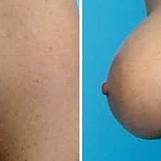 Breast Lift With Augmentation Before & After