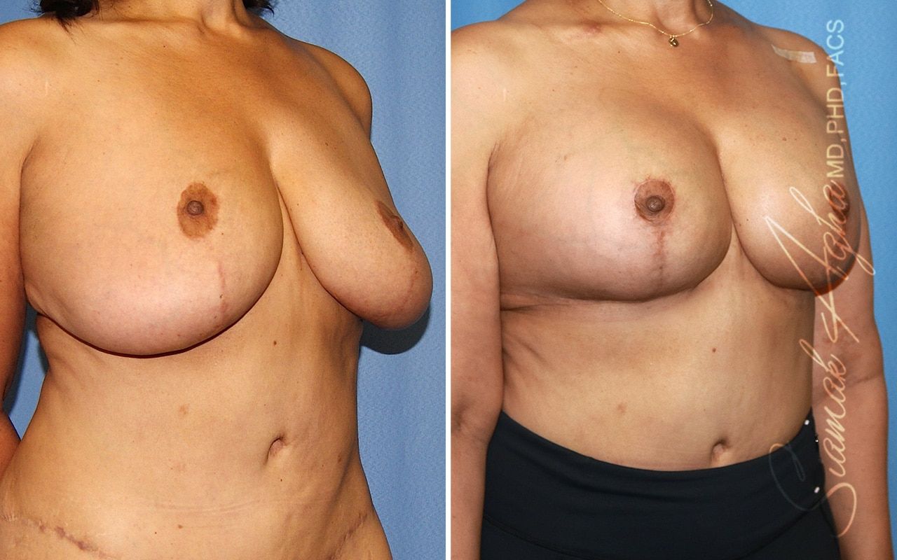 Before and after breast procedure comparison image.